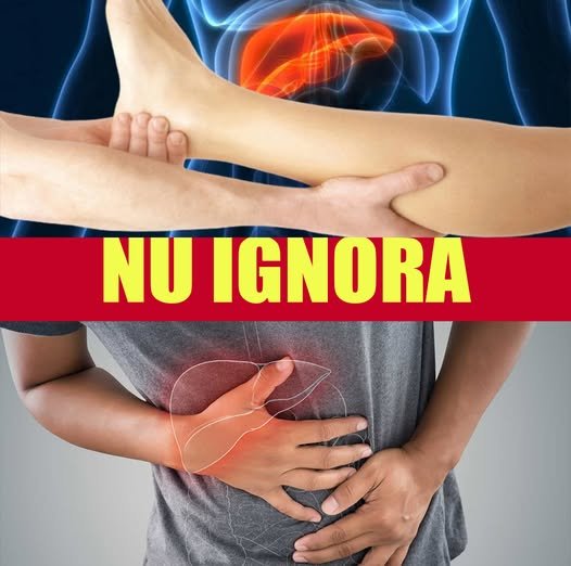 Boala ficatului gras non-alcoolic (NASH) – o afecțiune tăcută care poate duce la complicații grave
