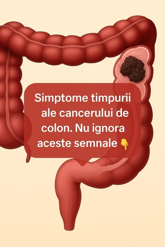 Simptome timpurii ale cancerului de colon. Cum recunoști boala din timp și când trebuie să mergi la medic