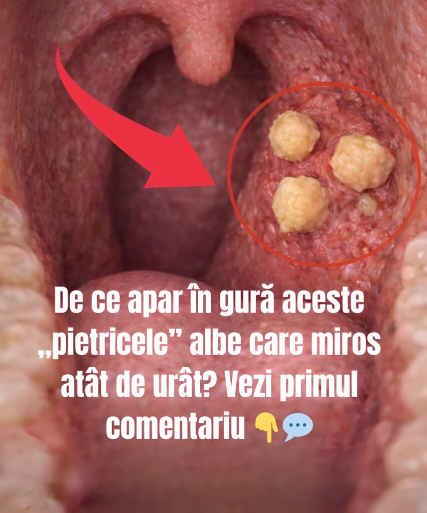 De ce apar în gură acele mici pietricele albe, urât mirositoare?